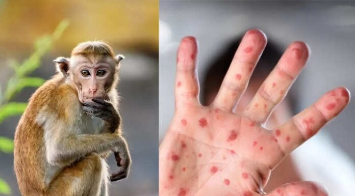 मंकीपॉक्स म्हणजे काय ? मंकीपॉक्सची सर्व लक्षणे कोणती ?
