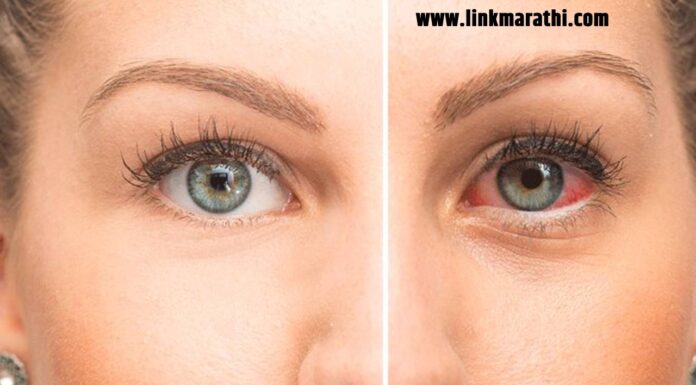 Dry Eye Disease : कोरड्या डोळ्यांचा आजार : कारणे आणि प्रभावी उपचार समजून घेणे | Dry Eye Disease: