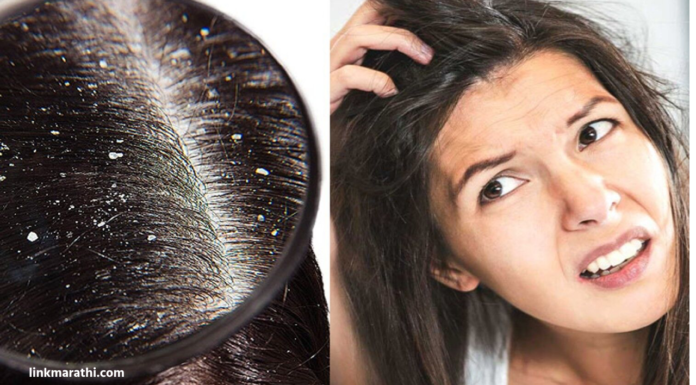 Dandruff Problem During Monsoon:ह्या पावसाळ्यात प्रभावी घरगुती उपायांसह खाज सुटलेल्या टाळू आणि चिकट केसांना अलविदा म्हणा Dandruff Problem During Monsoon