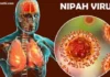 Nipah Virus Alert:कोविड-19 नंतर निपाह व्हायरस केरळमध्ये पुन्हा उद्भवला;हाय अलर्ट जारी|Nipah virus re-emerges in Kerala after Kovid-19;high alert issued Nipah Virus Alert